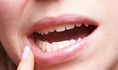 ¿Cómo detectar si sufres gingivitis?