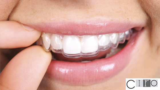 Invisalign ortodoncia invisible