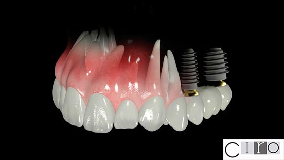 Tecnología avanzada para tus implantes dentales computerizados
