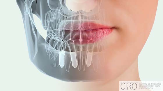 Implantes dentales en un solo día y con garantías