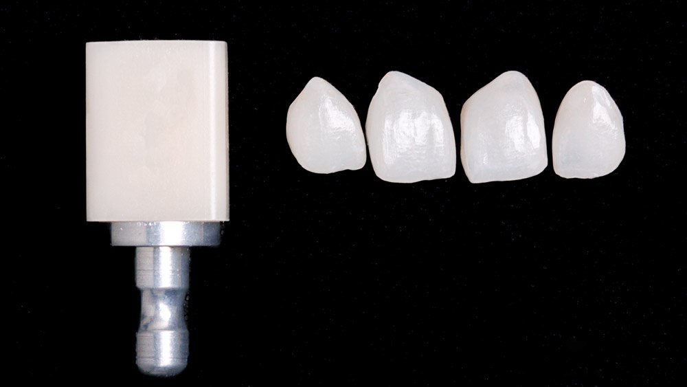 Carillas-dentales-CIRO-clinica-dental-Madrid-1-1