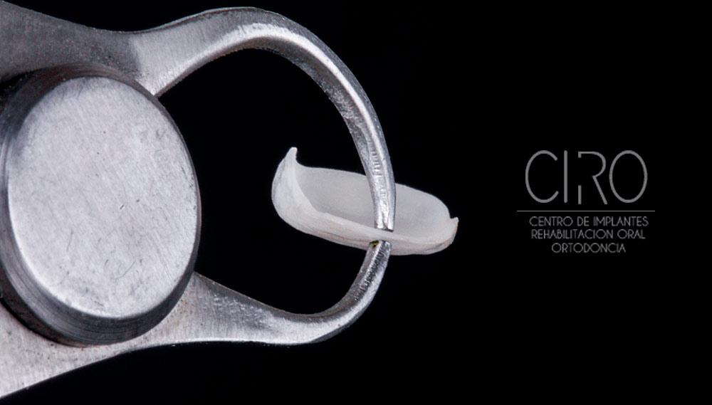 El secreto de una sonrisa perfecta: Carillas dentales