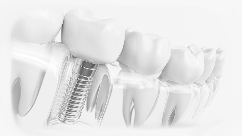 implantes-dentales-inmediato-madrid