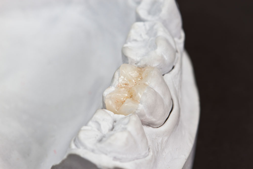 Desgaste dental patológico: causas y tratamiento