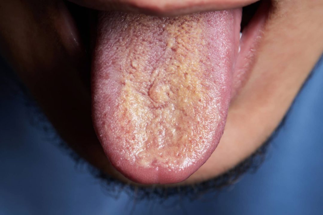 halitosis_texto-1080x721.jpg