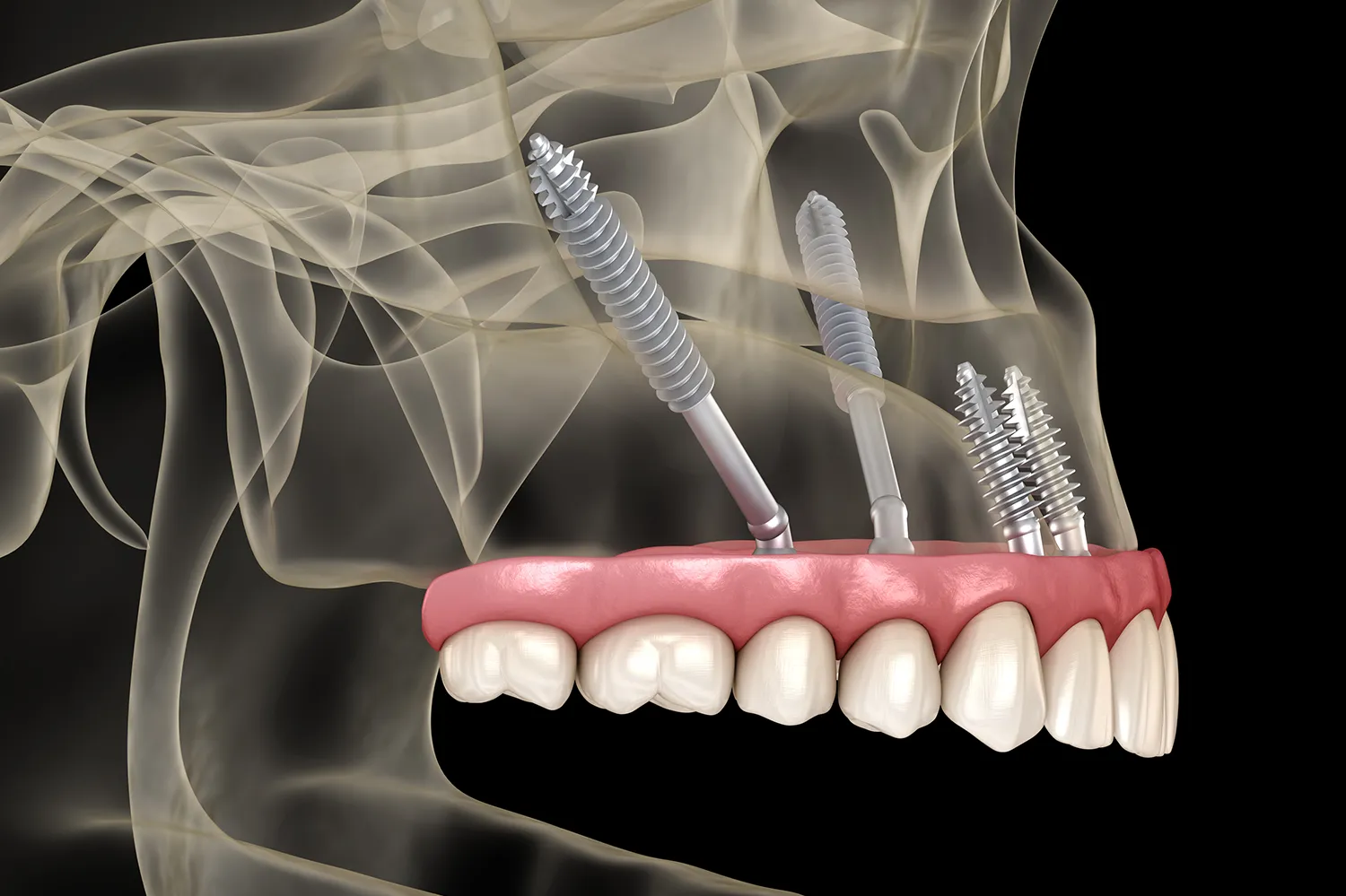 Implantes cigomáticos
