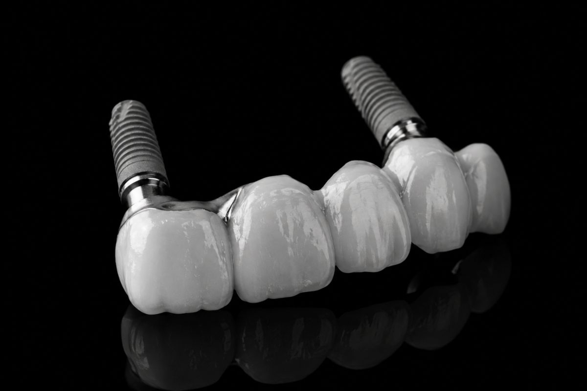 Prótesis fija sobre implantes dentales con planificación digital en Clínica CIRO Madrid