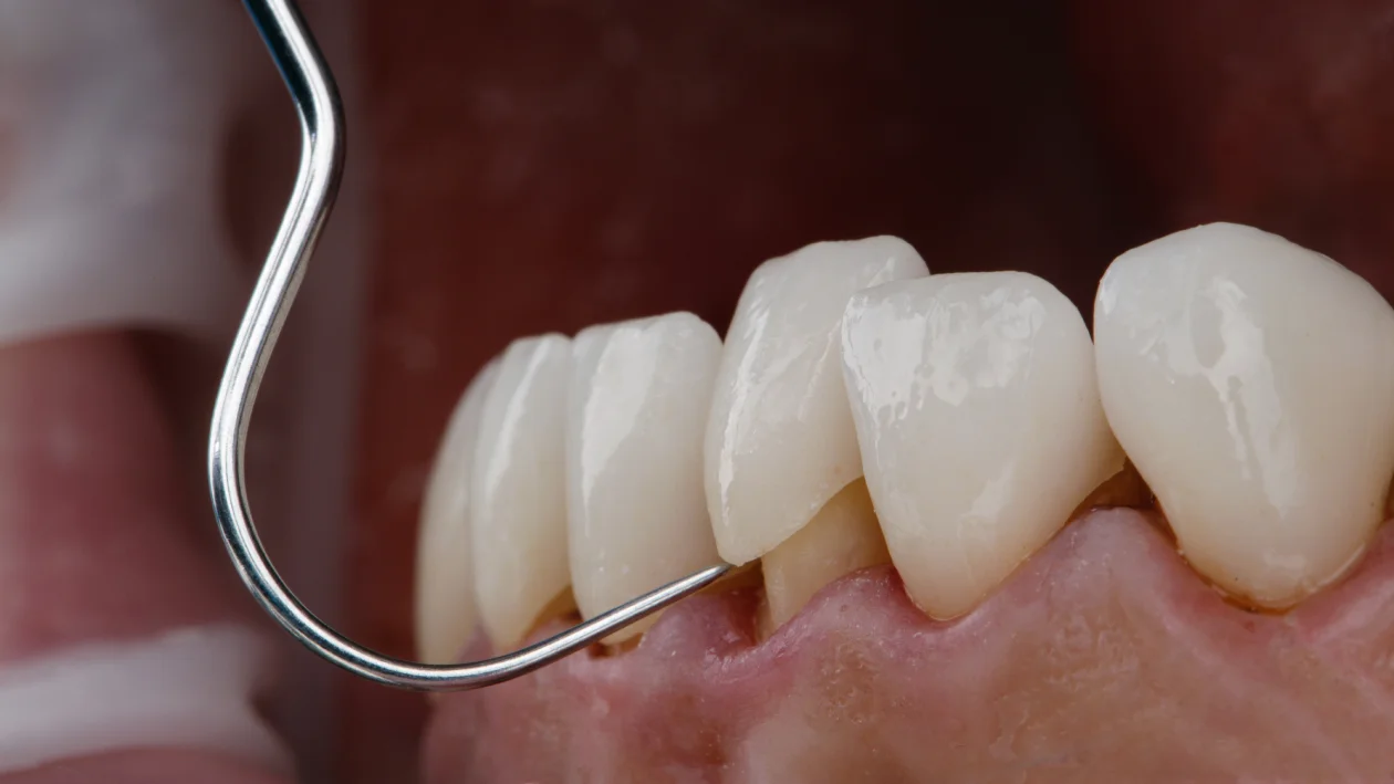 Carillas dentales en CIRO